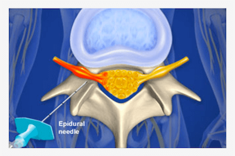 Back Pain Treatment Caused By Herniated Disc: Epidural Nerve Blocks