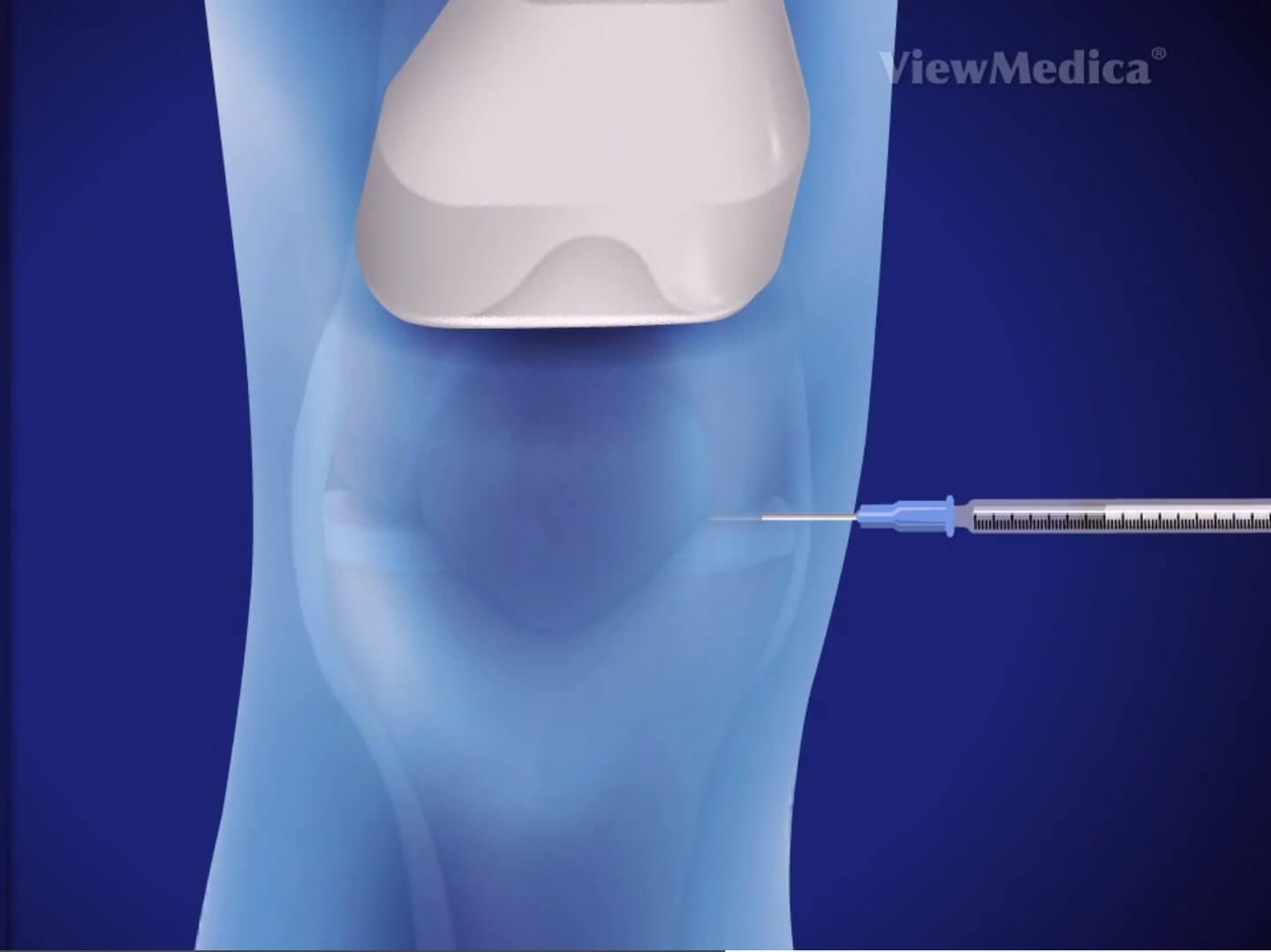 Viscosupplementation | Treatment For Knee Arthritis