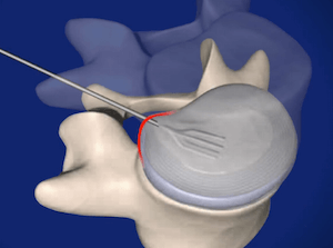 Herniated Disc Treatment: Percutaneous Discectomy